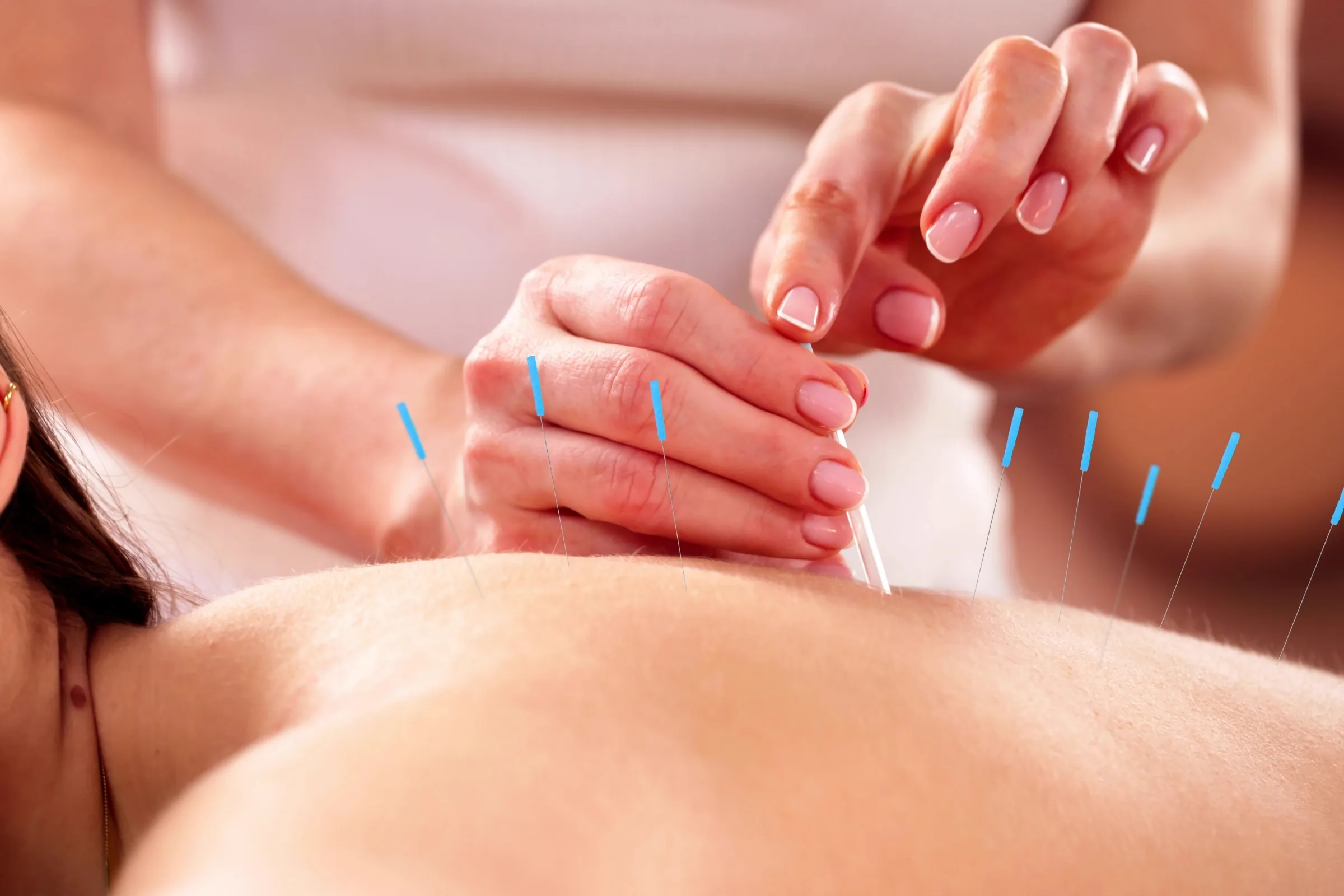 Licensed acupuncturist placing fine, single-use needles in a patient's upper back at Active Spine & Joint Institute